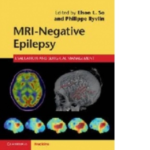 MRI - Negative Epilepsy
