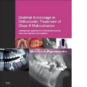 Skeletal Anchorage in Orthodontic Treatment of Class II Malo
