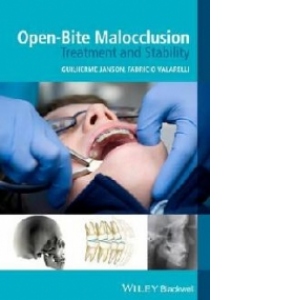 Open-Bite Malocclusion