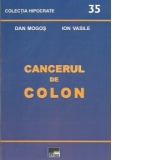 Cancerul de colon